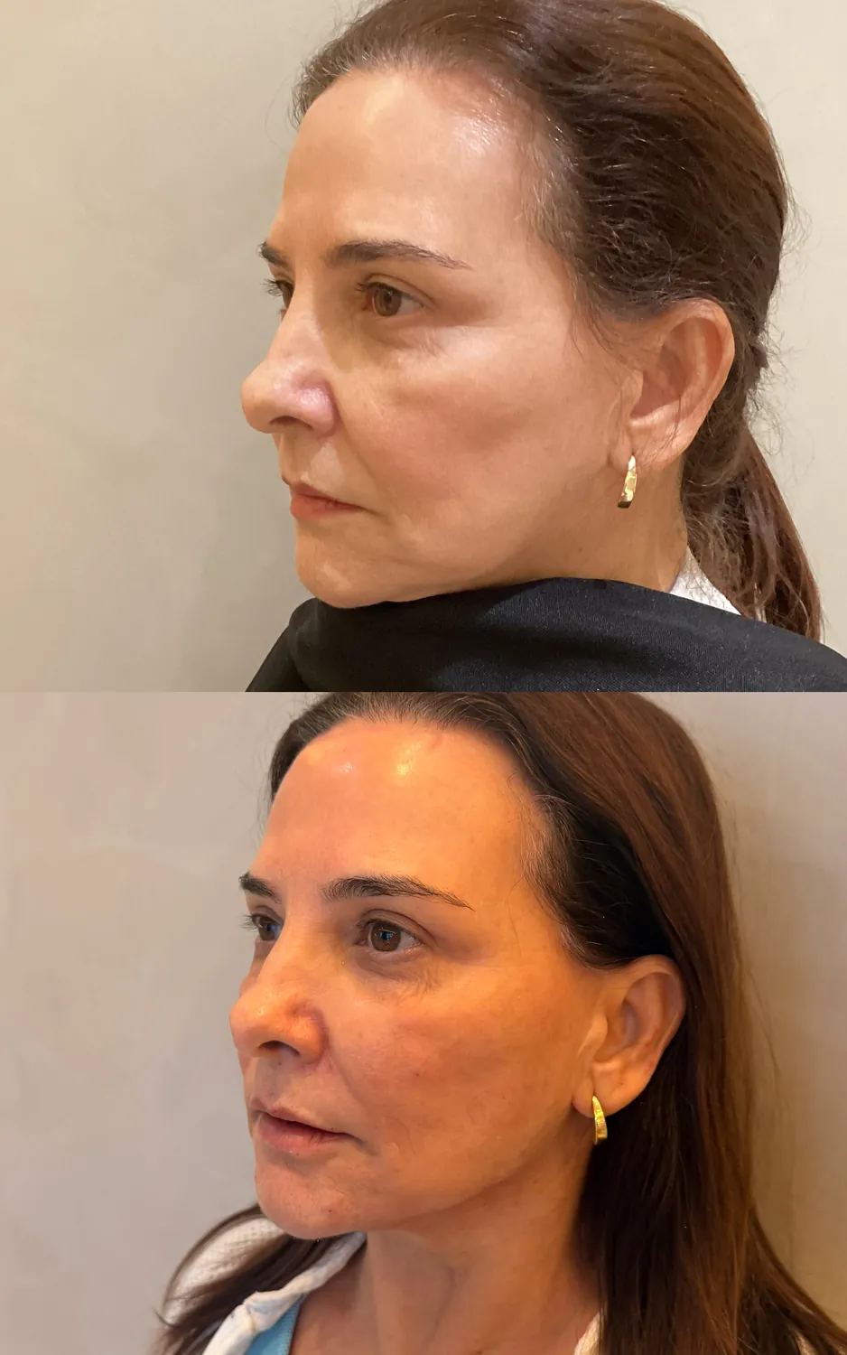 Antes e depois de paciente do Instituto, resultado 1
