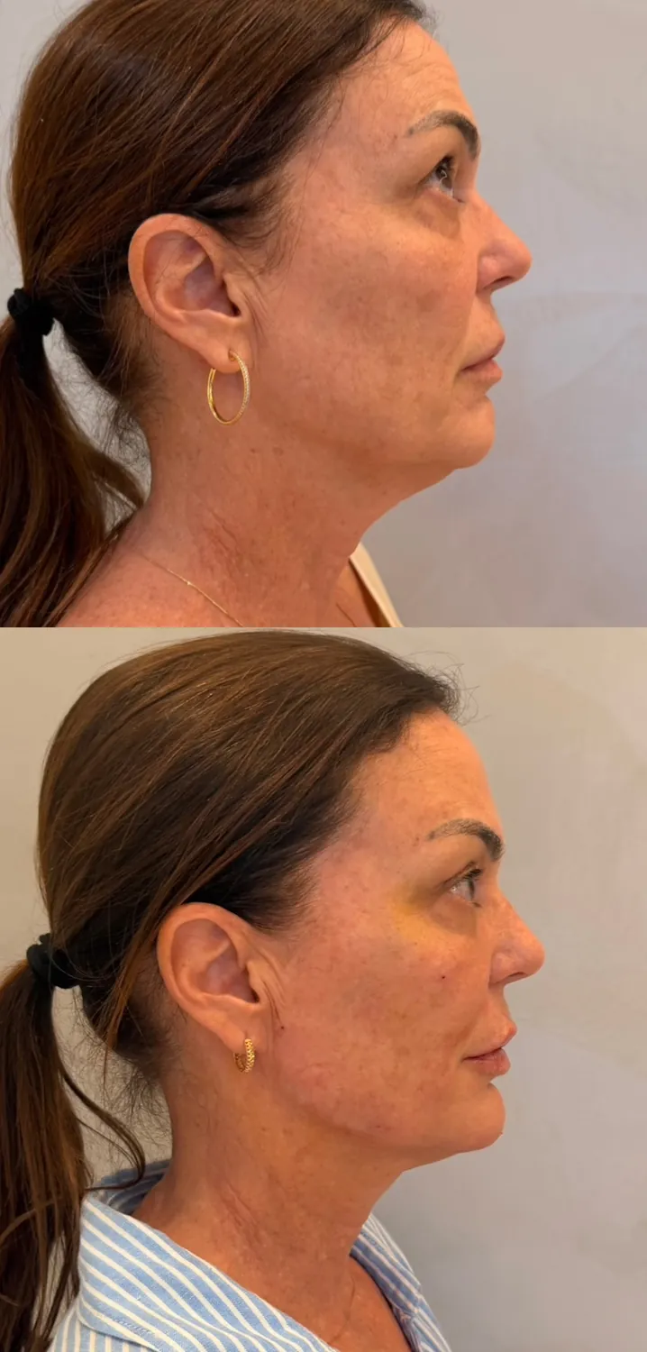 Antes e depois de paciente do Instituto, resultado 2